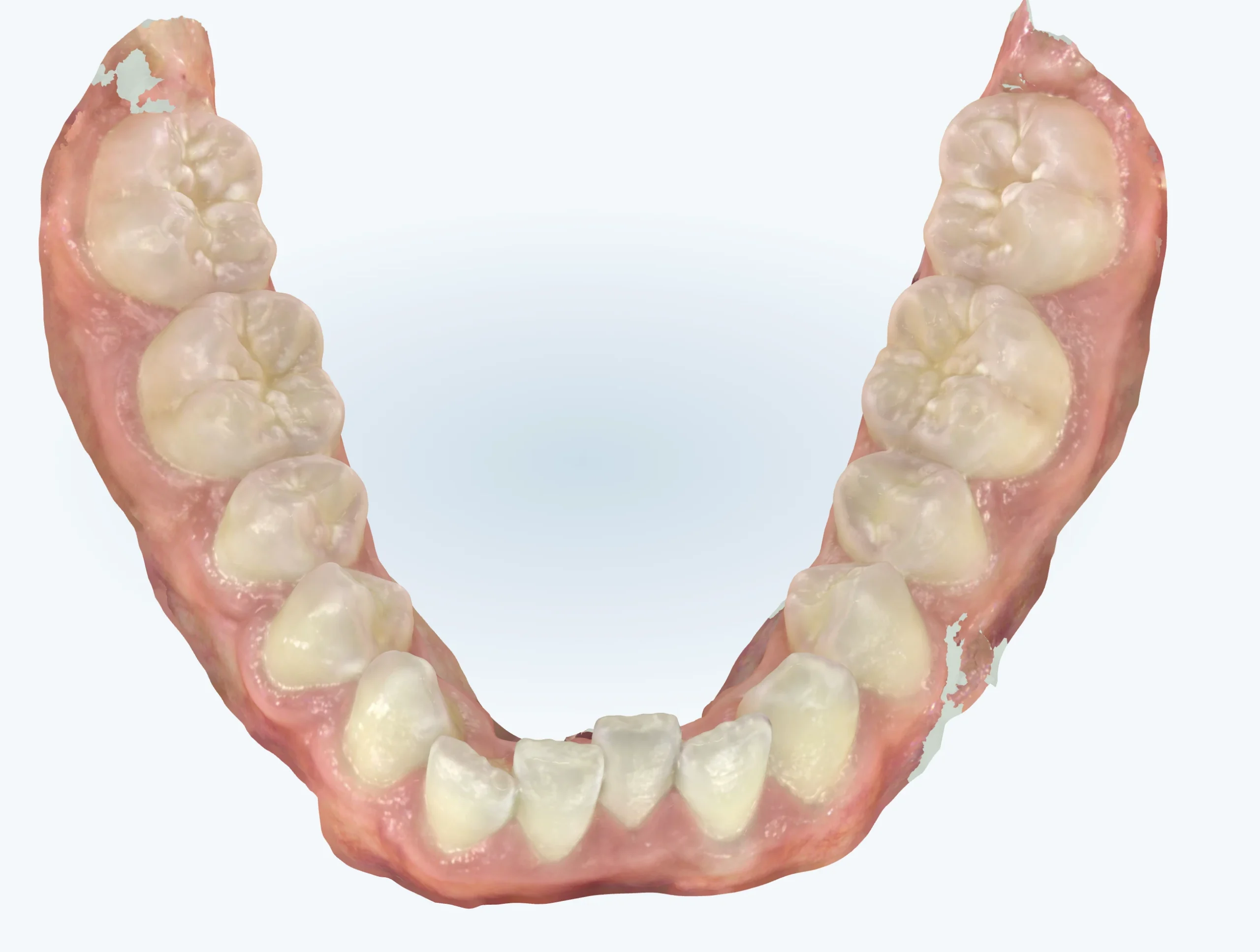 Narrow lower jaw before expansion