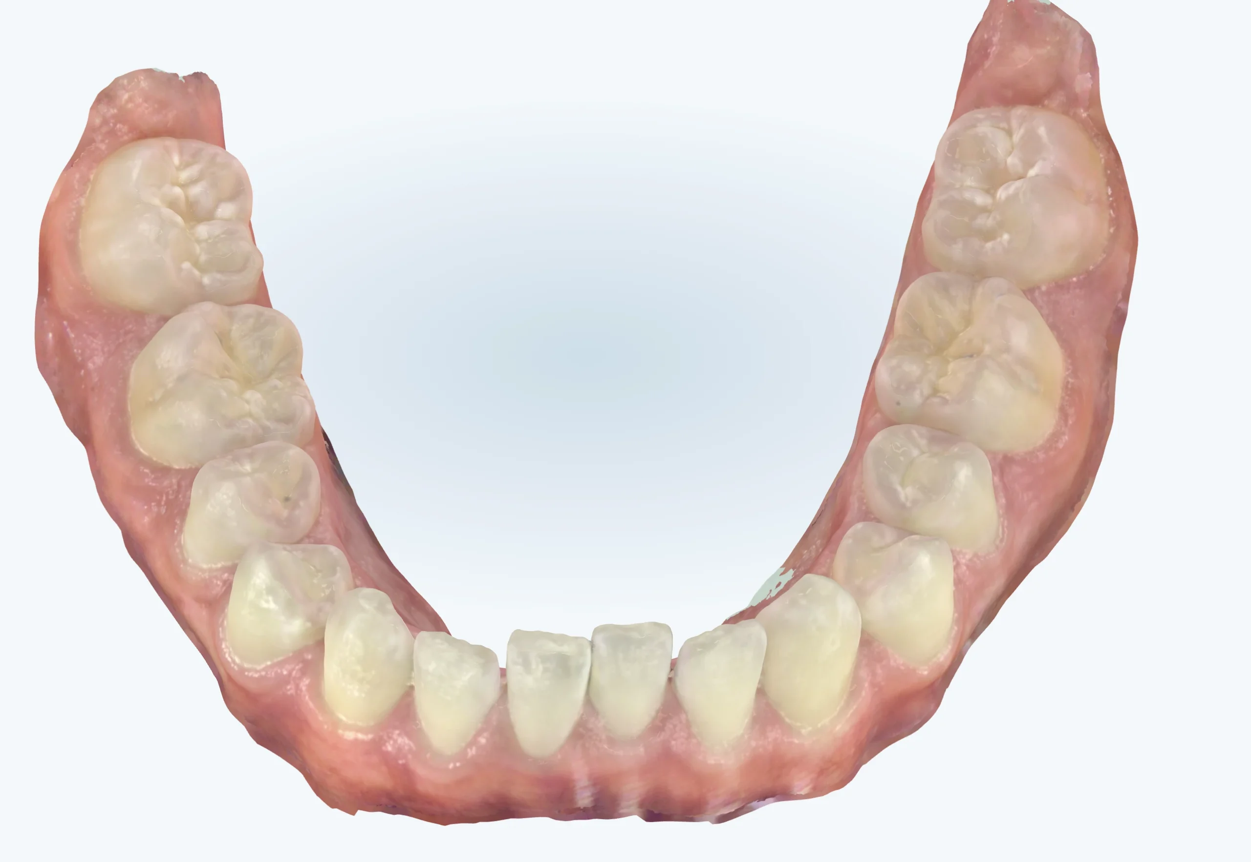 Wider lower jaw after expansion