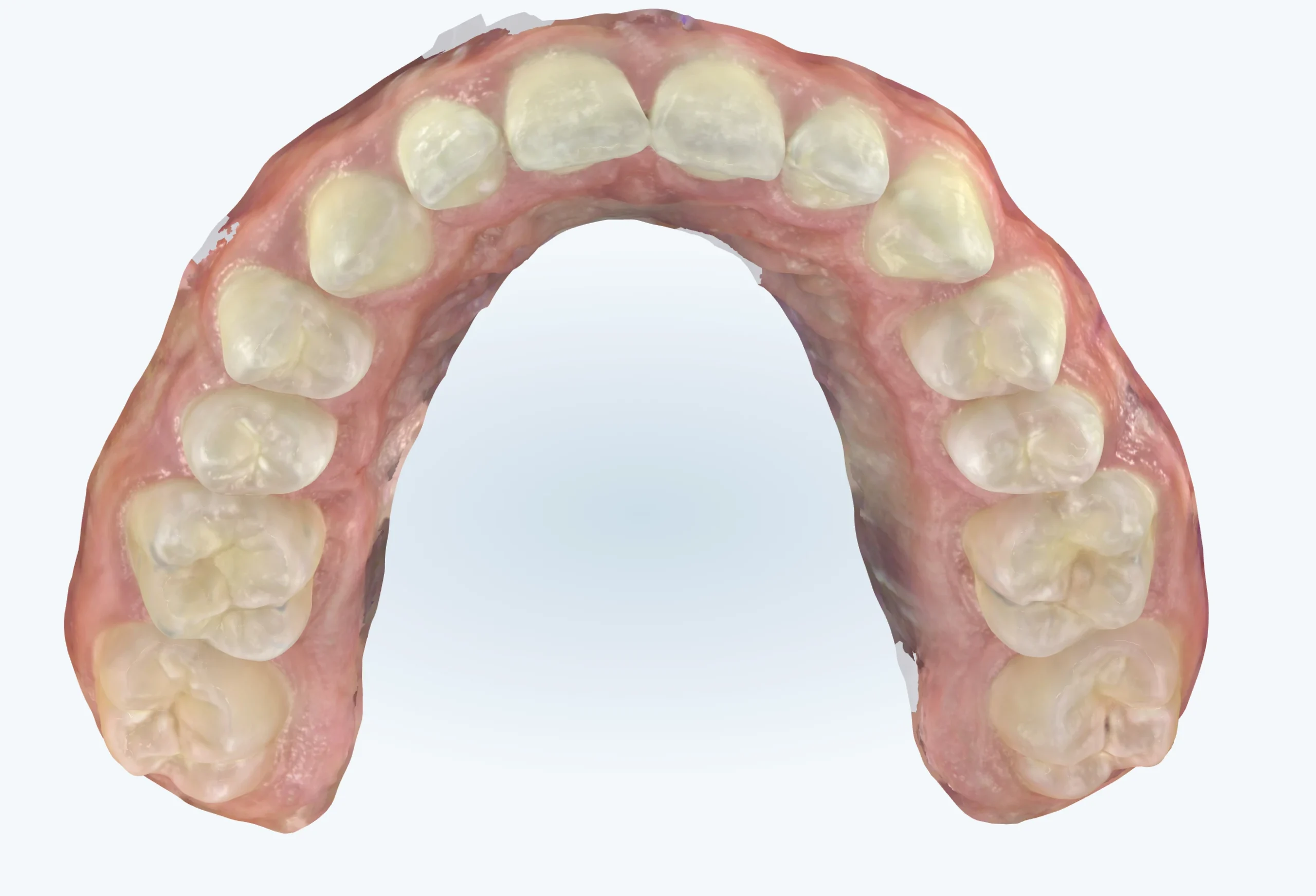 Upper palate expansion results at The Dentist Lounge, Santa Monica