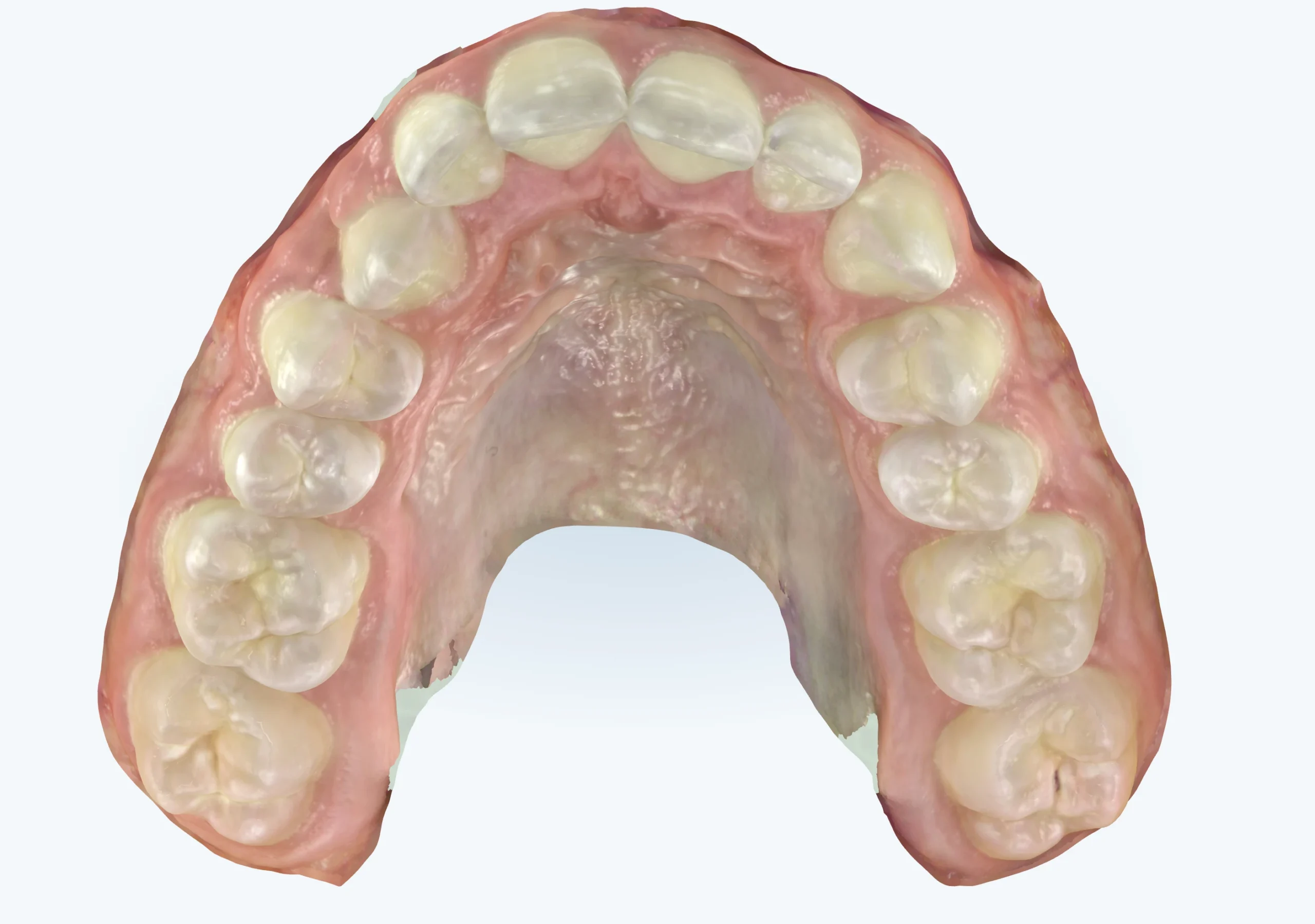 Narrow upper palate before expansion, age 14