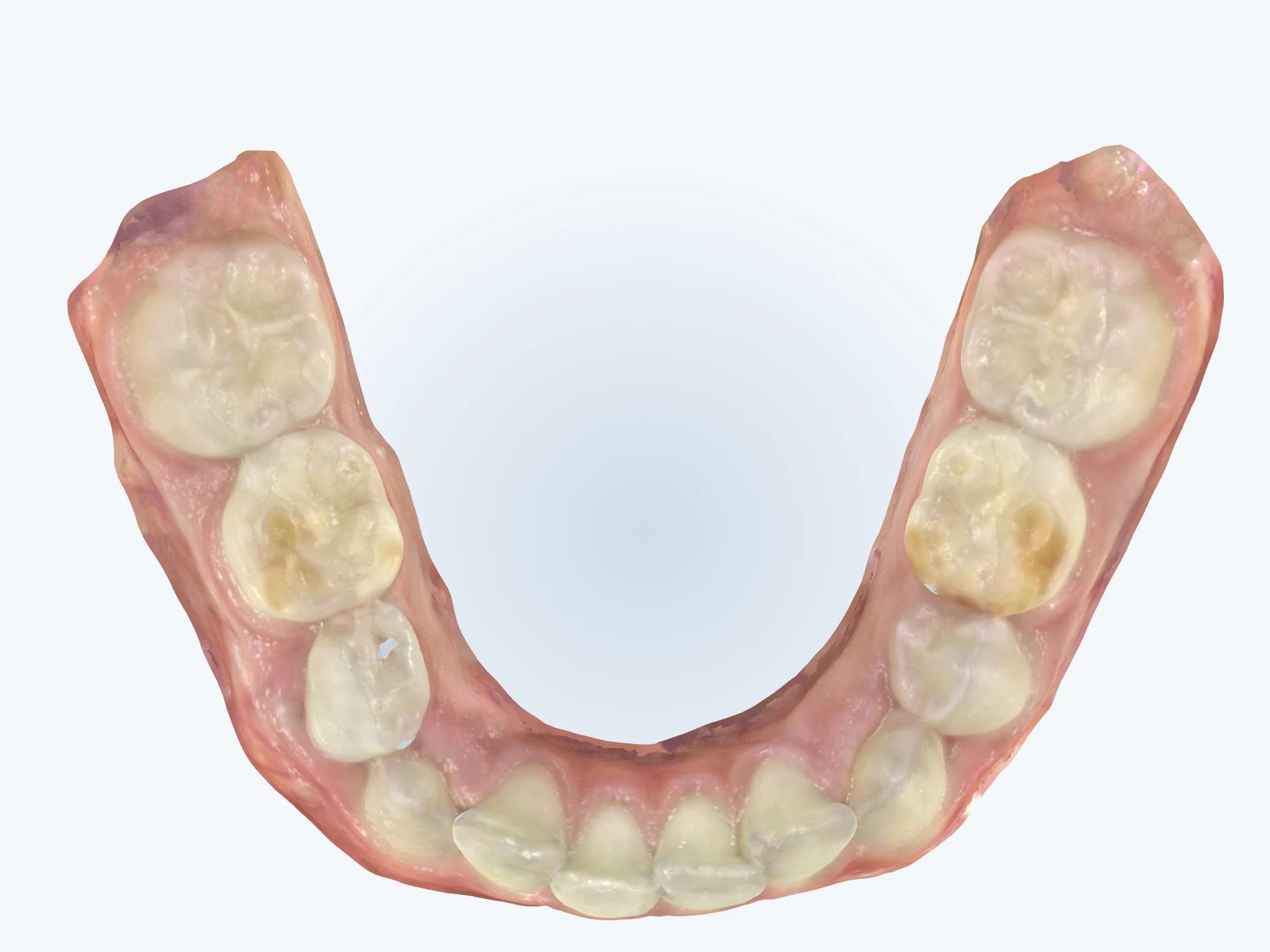 Crowded teeth and narrow palate before expansion, patient L