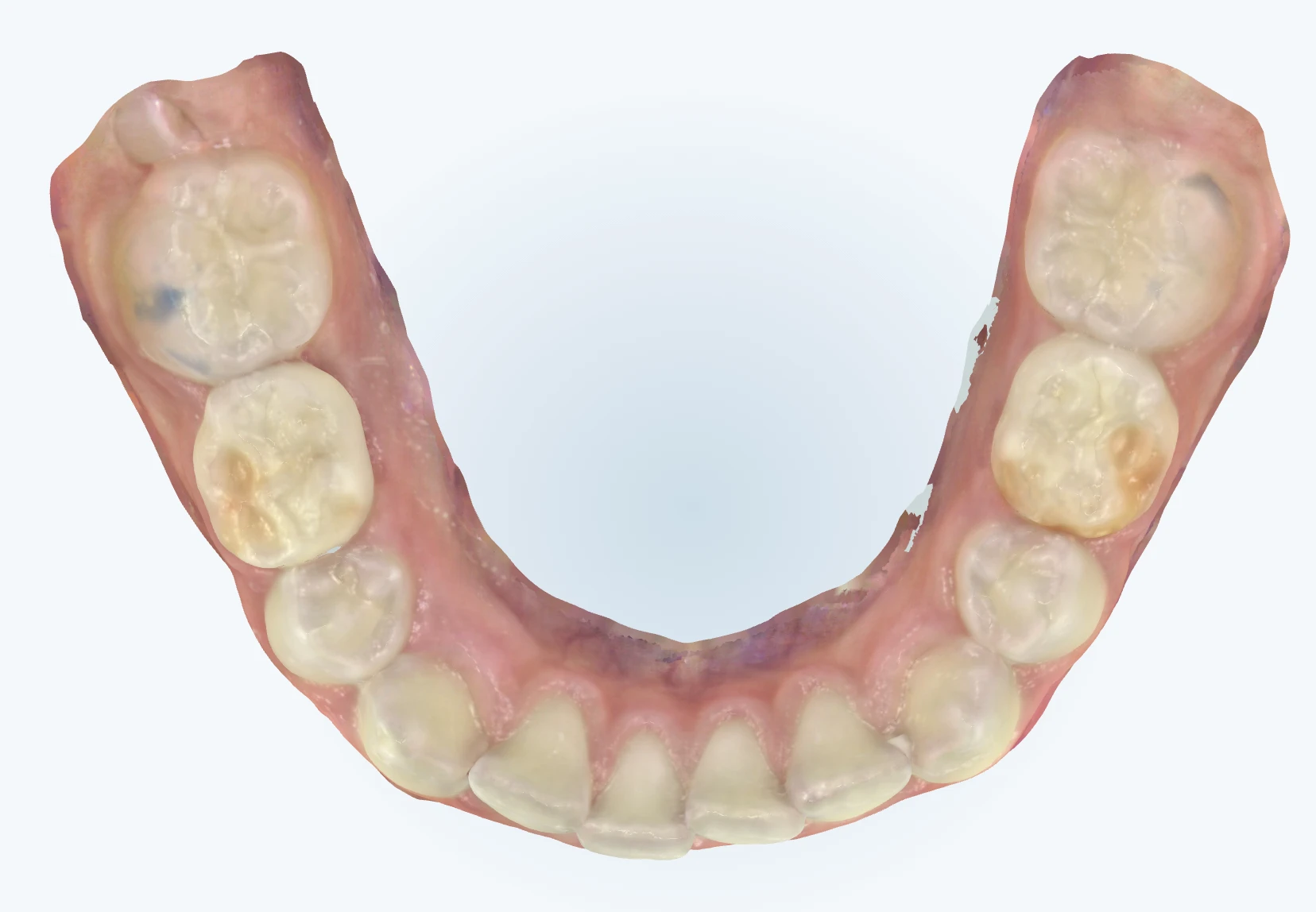 Improved arch width after expansion, patient L, age 10