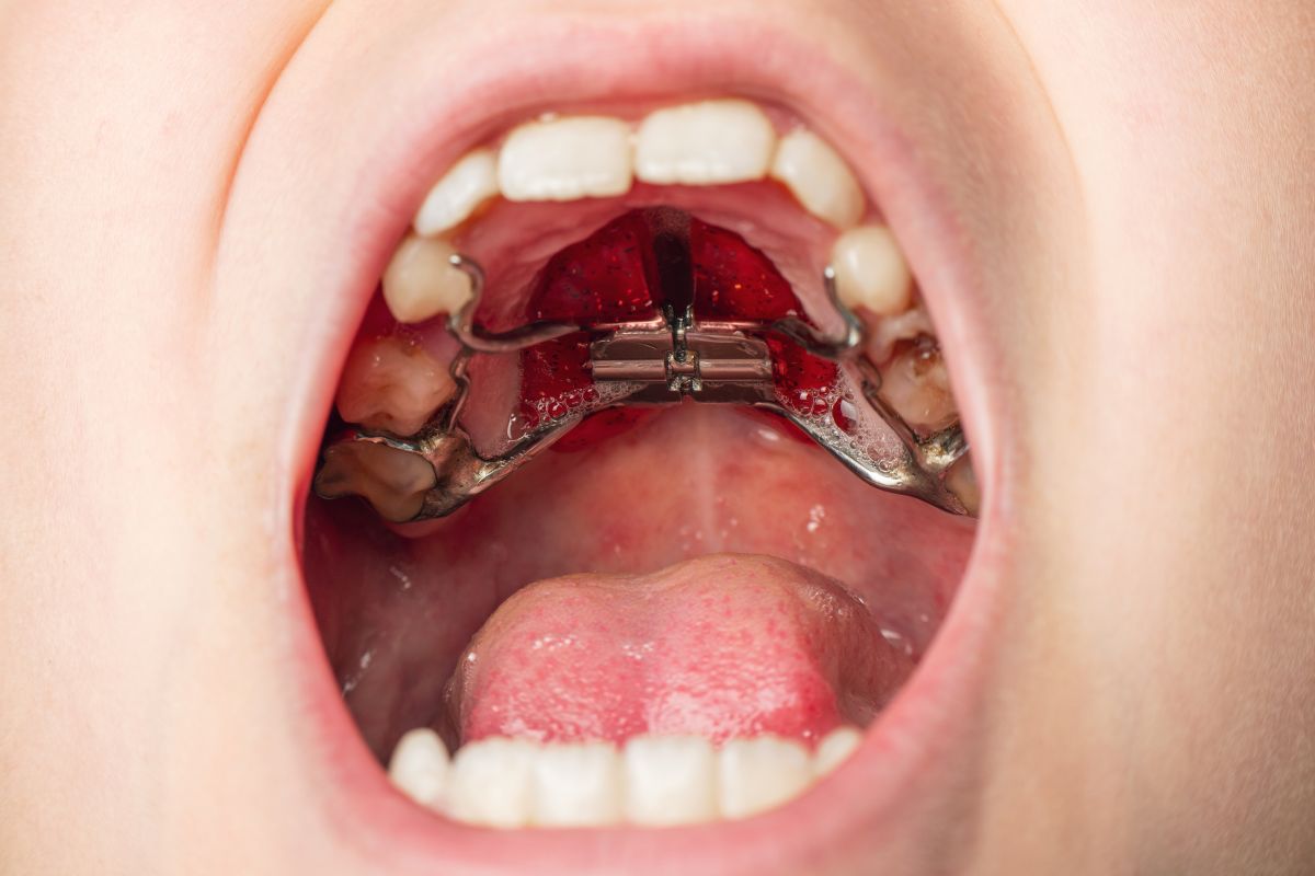 Upper palate expansion results at The Dentist Lounge, Santa Monica