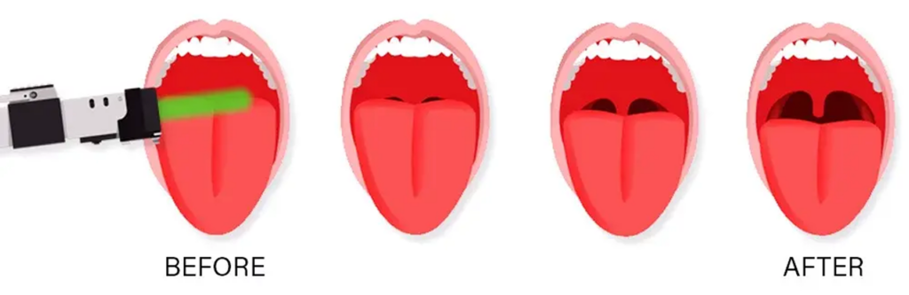 Four open mouths labeled BEFORE and AFTER; the first shows a dental laser emitting a green beam toward the tongue, followed by three AFTER frames.