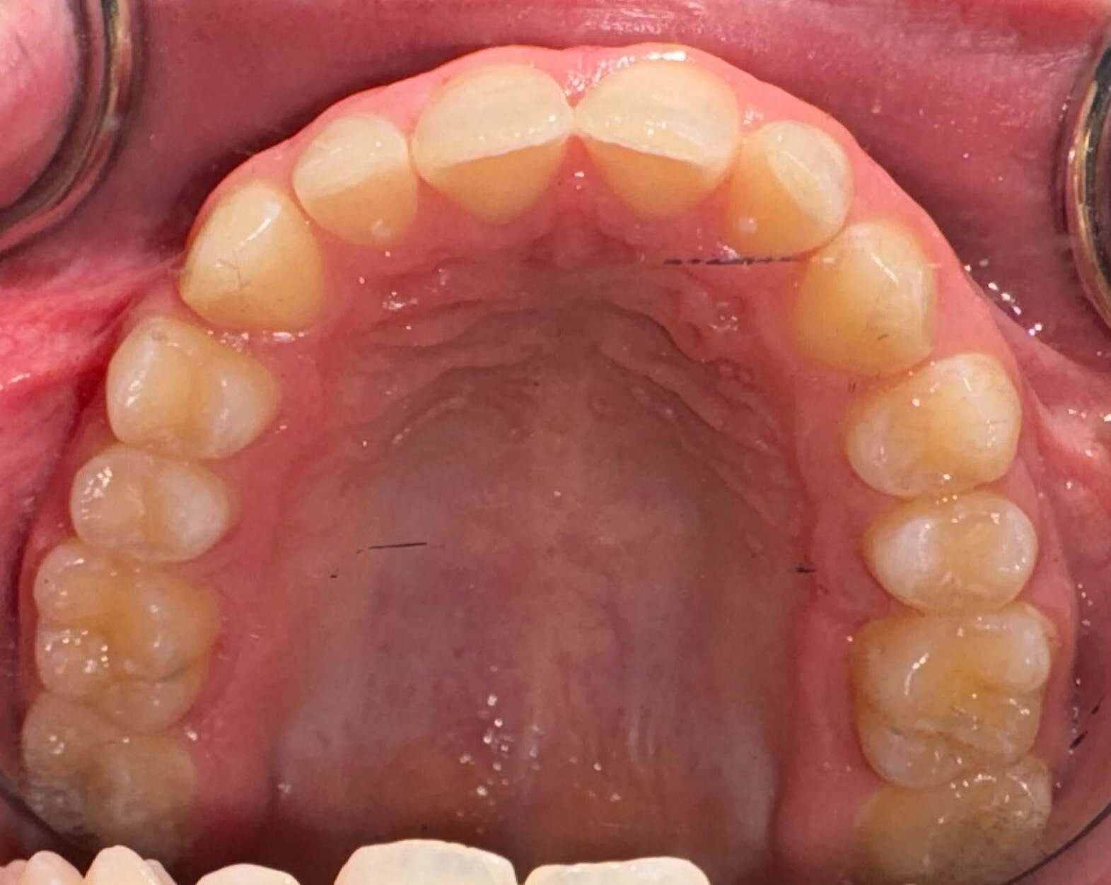 Wider upper palate after expansion