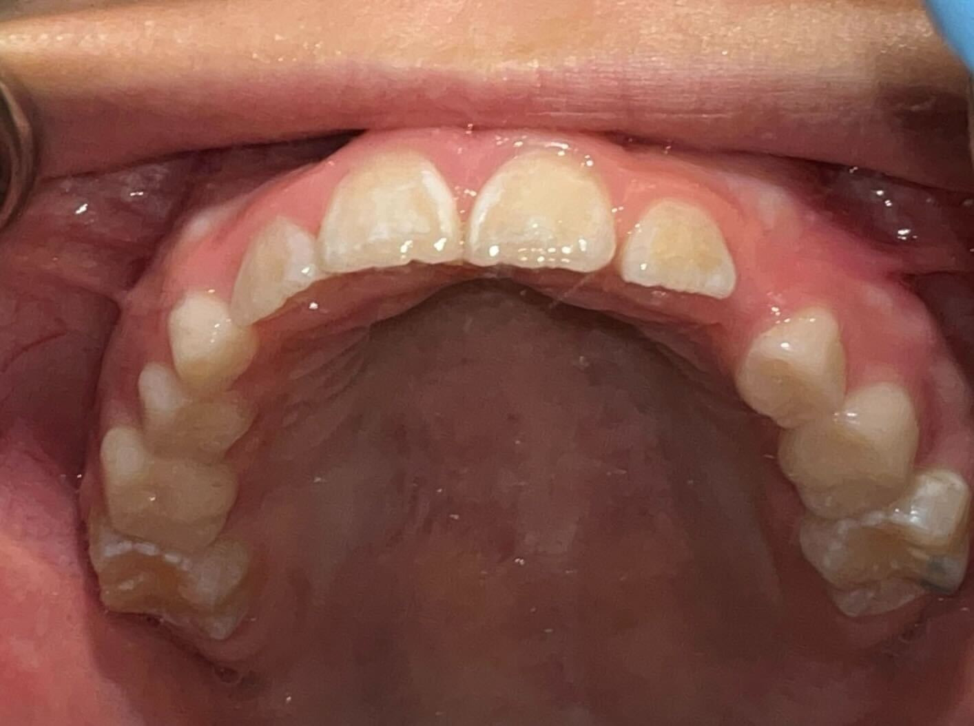 Improved arch width after expansion