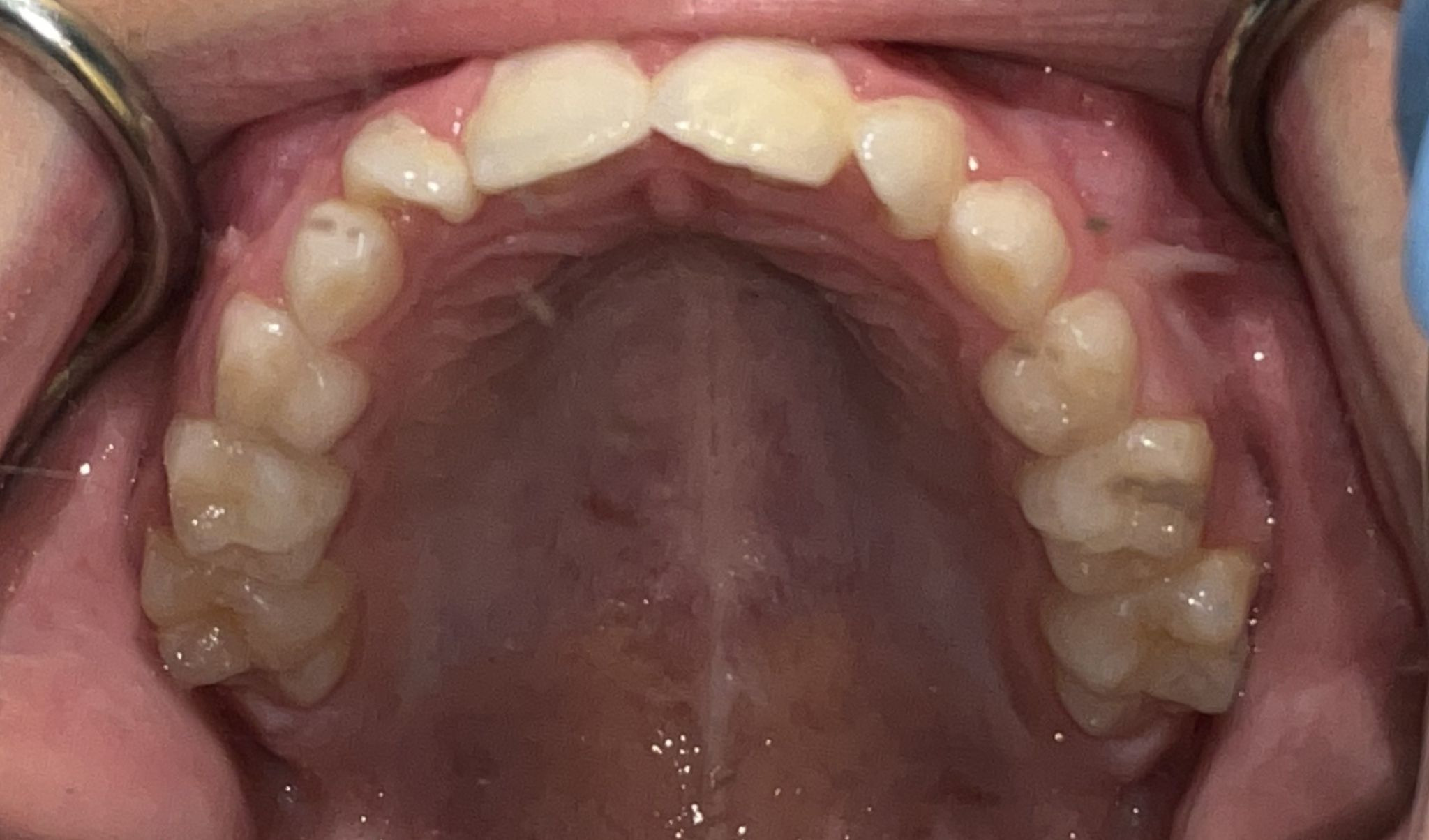 Wider arch after expansion