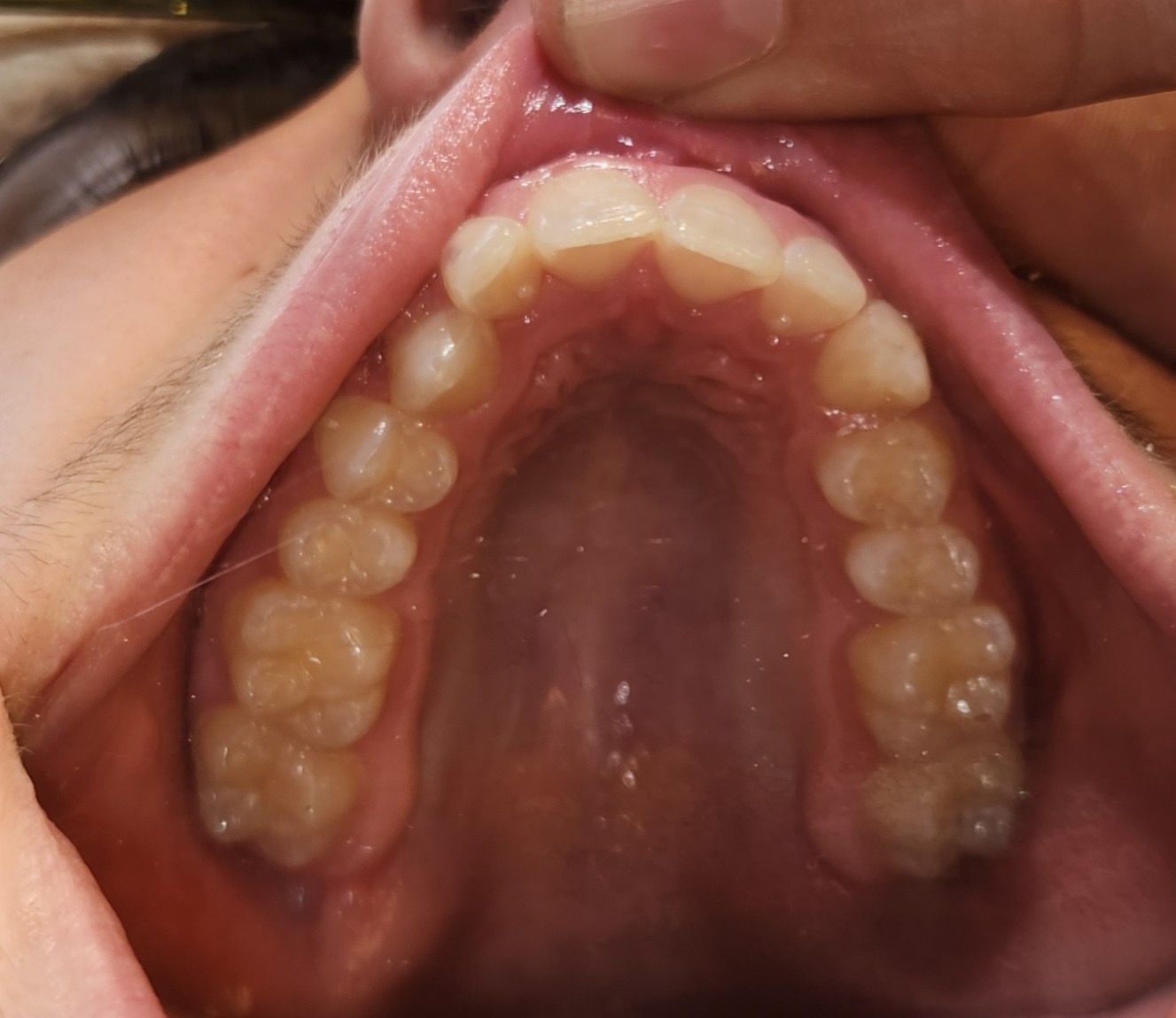 Narrow upper palate before expansion