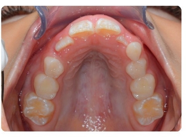 Crowded upper teeth before expansion
