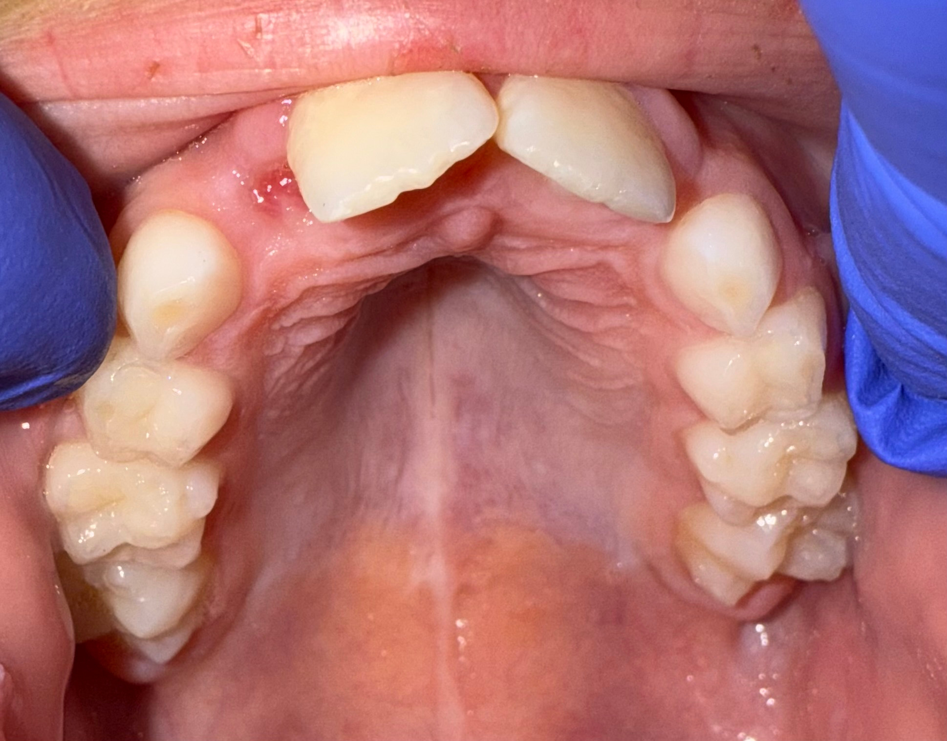 Narrow palate before expansion, anterior view