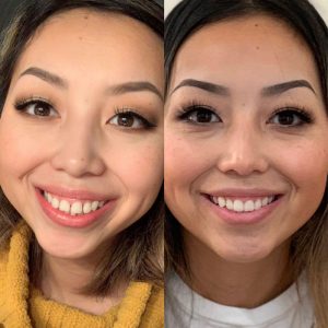 before-and-after-clear-aligner