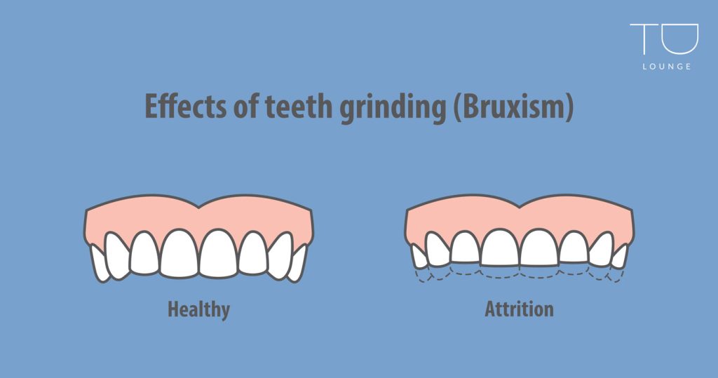 teeth-grinding-in-sleep