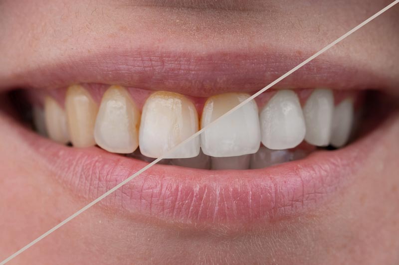 teeth-whitening-santa-monica