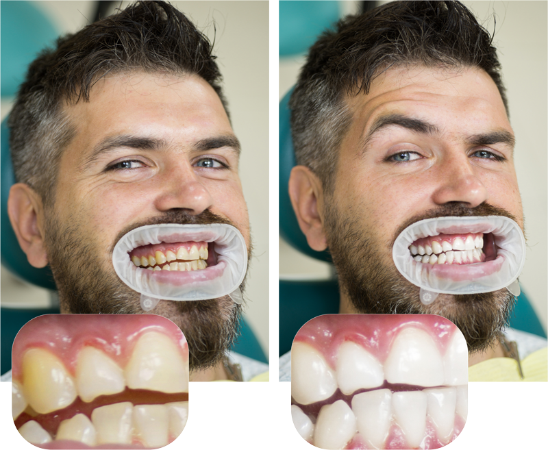 teeth-whitening-santa-monica